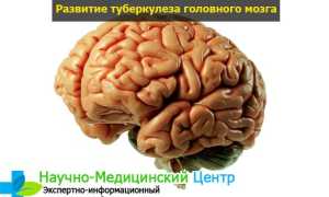 Туберкулез мозга: симптомы, разновидности, формы и способы лечения