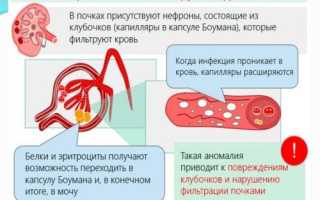 Гломерулонефрит с преобладанием нефротического синдрома