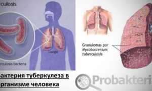 Бактерия – возбудитель туберкулеза: специфика и патогенез