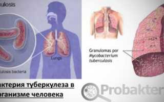 Бактерия – возбудитель туберкулеза: специфика и патогенез