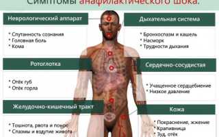 Анафилактический шок (анафилаксия): причины, симптомы, неотложная помощь