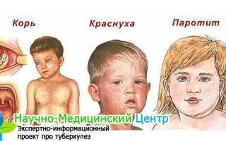 Прививка от заболеваний корь, краснуха и паротит: как переносится в 1 год, график вакцинации