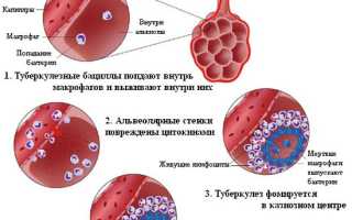 Как определить туберкулез: важнейшие симптомы и методы диагностики
