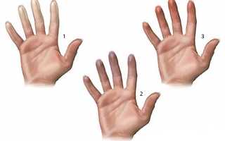 Синдром Рейно: причины, симптомы и лечение