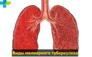 Туберкулез милиарный: симптомы и лечение