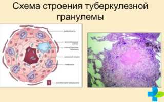 Строение туберкулезной гранулемы в легком