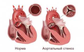 Стеноз аортального клапана: что это такое, как лечить и стоит ли бояться