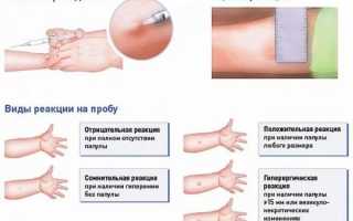 Постановка пробы манту