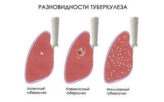 Современная классификация и формы туберкулёза