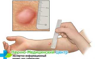 Положительная реакция Манту у ребёнка, что делать?