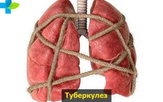 Что это за болезнь – кавернозный туберкулёз?