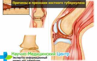 Таблетки от туберкулеза Изониазид, применение, противопоказания