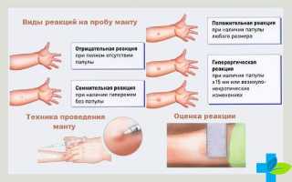 Как часто делают реакцию Манту детям
