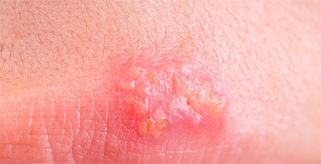 Пузырьковые высыпания на коже Пузырьковые высыпания на коже