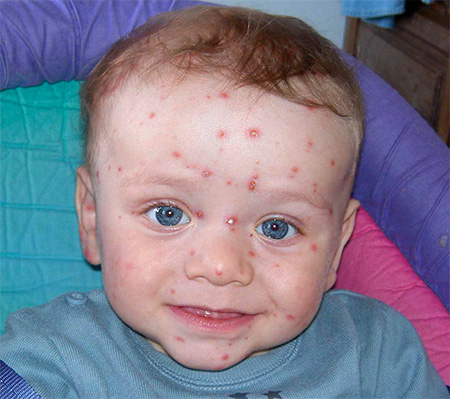 При ветрянке особеннно важно не допустить развития осложнений, сопутствующих этому заболеванию. При ветрянке особеннно важно не допустить развития осложнений, сопутствующих этому заболеванию.