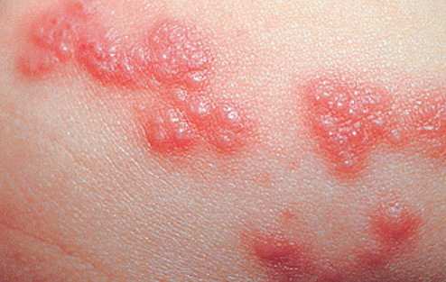 Типичные пузырьковые высыпания Типичные пузырьковые высыпания