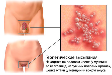 В первую очередь поражаются половые органы и близлежащие участки кожи В первую очередь поражаются половые органы и близлежащие участки кожи