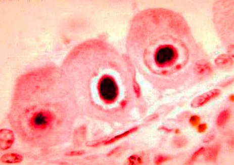 Пораженные инфекцией клетки напоминают совиный глаз. Пораженные инфекцией клетки напоминают совиный глаз.