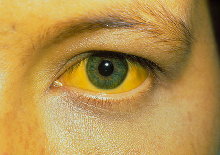 Одним из признаков ЦМВ-инфекции может быть желтуха. Одним из признаков ЦМВ-инфекции может быть желтуха.