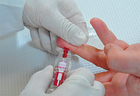 В России цитомегаловирус у ребенка обычно диагностируют с помощью иммуноферментного метода анализа (ИФА), определяя наличие соответствующих антител в крови. Диагностика (анализ) цитомегаловируса у детей