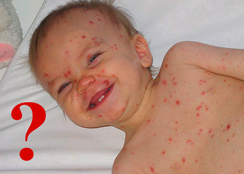 Заболевание часто путают с краснухой. Заболевание часто путают с краснухой.