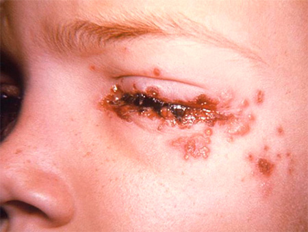 Герпетическое поражение глаза и прилегающих тканей Герпетическое поражение глаза и прилегающих тканей