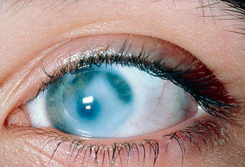 Помутнение роговицы глаза при офтальмогерпесе Помутнение роговицы глаза при офтальмогерпесе