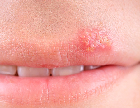 Герпетические язвочки на губах Герпетические язвочки на губах