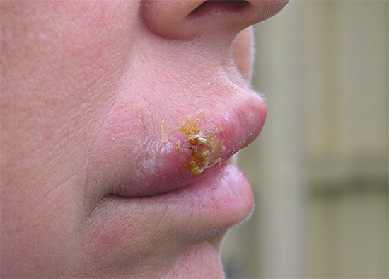 Даже если корки на губах уже подсохли, лечение мазью должно продолжаться до 5 дней. Даже если корки на губах уже подсохли, лечение мазью должно продолжаться до 5 дней.