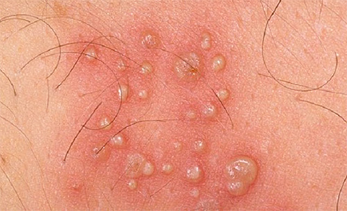 Характерным симптомом является появление язвочек на коже Характерным симптомом является появление язвочек на коже