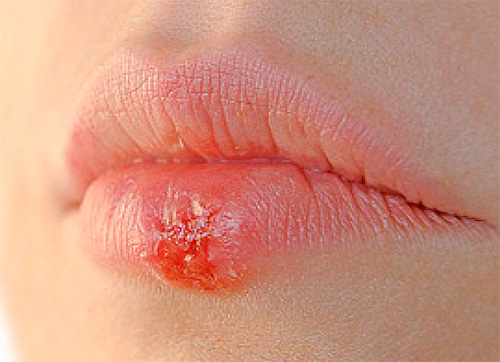 Обычную простуду на губах легко перенести по неосторожности в интимную область Обычную простуду на губах легко перенести по неосторожности в интимную область