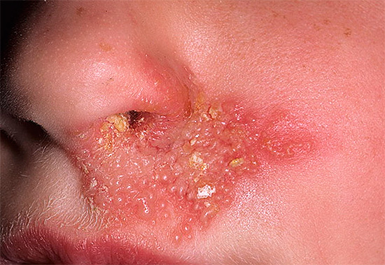 Поговорим об особенностях проявления герпетической инфекции в области лица и посмотрим, существуют ли способы быстрого лечения этой патологии... Поговорим об особенностях проявления герпетической инфекции в области лица и посмотрим, существуют ли способы быстрого лечения этой патологии...