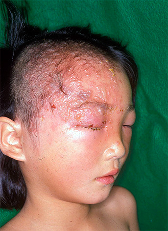 Опоясывающий лишай у детей встречается гораздо реже, чем у взрослых... Опоясывающий лишай у детей встречается гораздо реже, чем у взрослых...