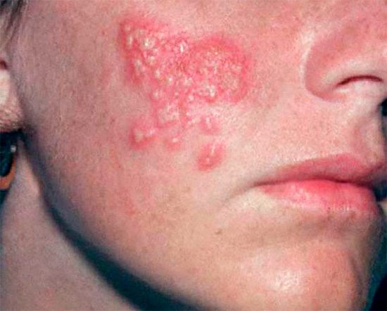 Герпетические высыпания на щеке Герпетические высыпания на щеке