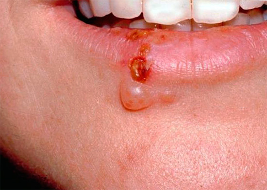 Зачастую язвочки не локализуется лишь на губах, захватывая также кожу под ними и на подбородке... Зачастую язвочки не локализуется лишь на губах, захватывая также кожу под ними и на подбородке.