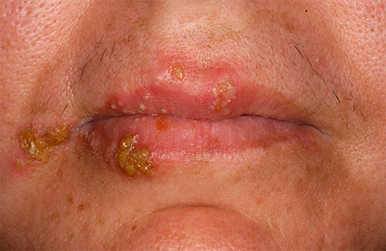 На фотографии показан классический пример простуды на губах, вызываемой вирусом HSV-1 (реже HSV-2). На фотографии показан классический пример простуды на губах, вызываемой вирусом HSV-1 (реже HSV-2).