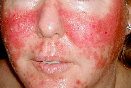 Опоясывающий лишай на лице вызывается вирусом Herpes zoster. Опоясывающий лишай на лице вызывается вирусом Herpes zoster.