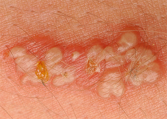 Так выглядят герпетические папулы (пузырьки). Так выглядят герпетические папулы (пузырьки).