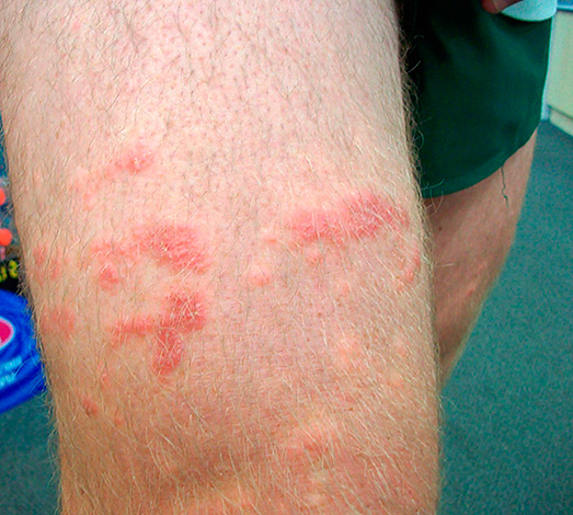 Выясняем, какие причины могут привести к появлению герпеса на ногах и насколько такая локализация патологии может быть опасной... Выясняем, какие причины могут привести к появлению герпеса на ногах и насколько такая локализация патологии может быть опасной...