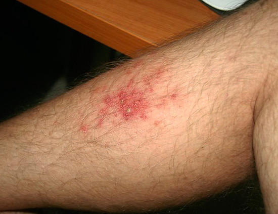 В большинстве случаев появление герпетических высыпаний на ногах не представляет собой серьезной угрозы для здоровья... В большинстве случаев появление герпетических высыпаний на ногах не представляет собой серьезной угрозы для здоровья...