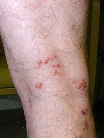 Пример появления герпеса на сгибе ноге. Пример появления герпеса на сгибе ноги.