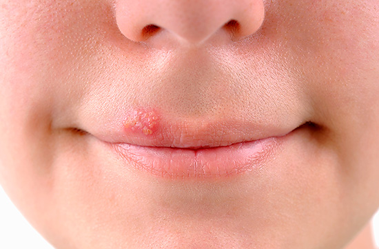 Простуда на губах Простуда на губах