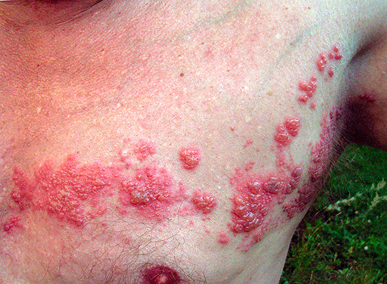 Реактивация вируса Varicella zoster приводит к опоясывающему герпесу. Реактивация вируса Varicella zoster приводит к опоясывающему герпесу.