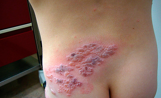 Высыпания на коже при опоясывающем герпесе могут быть весьма обширными, и иногда переходят, например, с пояса на ноги. Высыпания на коже при опоясывающем герпесе могут быть весьма обширными, и иногда переходят, например, с пояса на ноги.