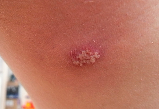 При простом герпесе высыпания, как правило, занимают небольшую площадь. При простом герпесе высыпания, как правило, занимают небольшую площадь.