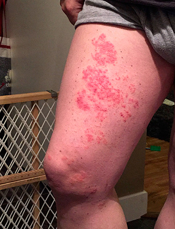 Иногда различные аллергические реакции, а также некоторые грибковые заболевания принимают за проявления герпеса. Иногда различные аллергические реакции, а также некоторые грибковые заболевания принимают за проявления герпеса.