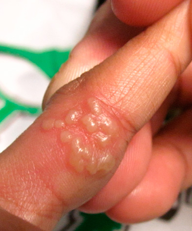 Герпетические язвочки может появиться не только на губах, но и, например, на пальцах рук - давайте посмотрим, опасно ли это и как лечить такое заболевание... Герпетические язвочки может появиться не только на губах, но и, например, на пальцах рук - давайте посмотрим, опасно ли это и как лечить такое заболевание...