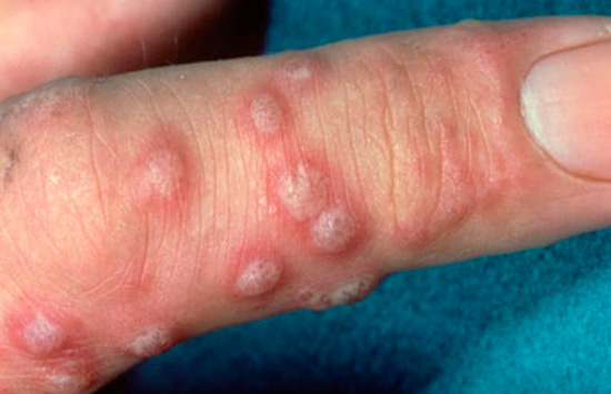 Герпес на пальце Герпес на пальце