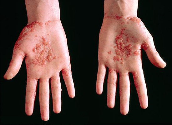 В тяжелых случаях заболевание может поражать значительную часть ладоней... В тяжелых случаях заболевание может поражать значительную часть ладоней...