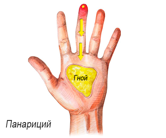 Бактериальный панариций по своим симптомам существенно отличается от герпетического. Бактериальный панариций по своим симптомам существенно отличается от герпетического.